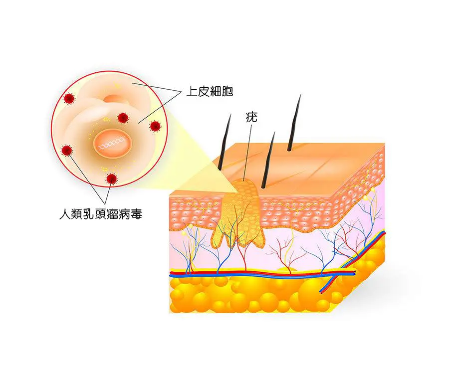 疣速消除疣啫喱:圖片 6