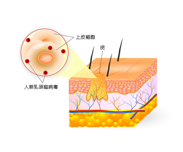 疣速消除疣啫喱：圖片 2